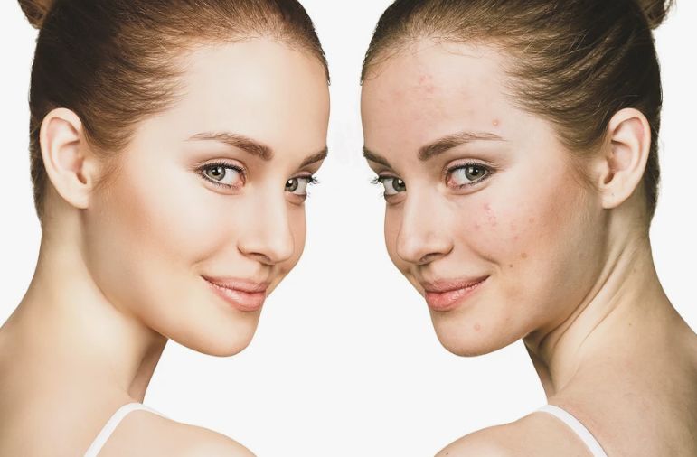 Before &After